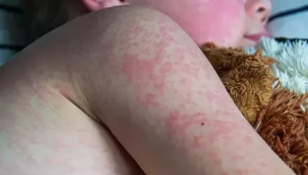 ABD’de kızamıktan ölen çocuğun babası: ‘Aşıya güvenmiyoruz’